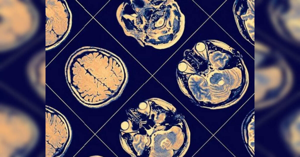 Neurocrine halts development of schizophrenia drug as trial fails, ETHealthworld