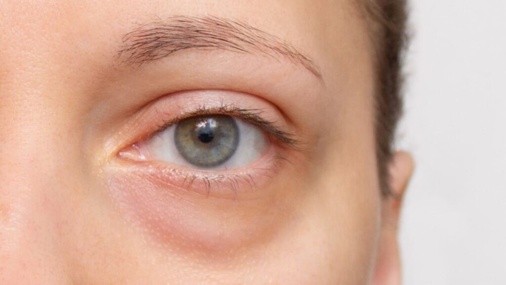 Suffering from swollen, puffy eyes? Dermatologist shares why this may happen and how to reduce puffiness | Health