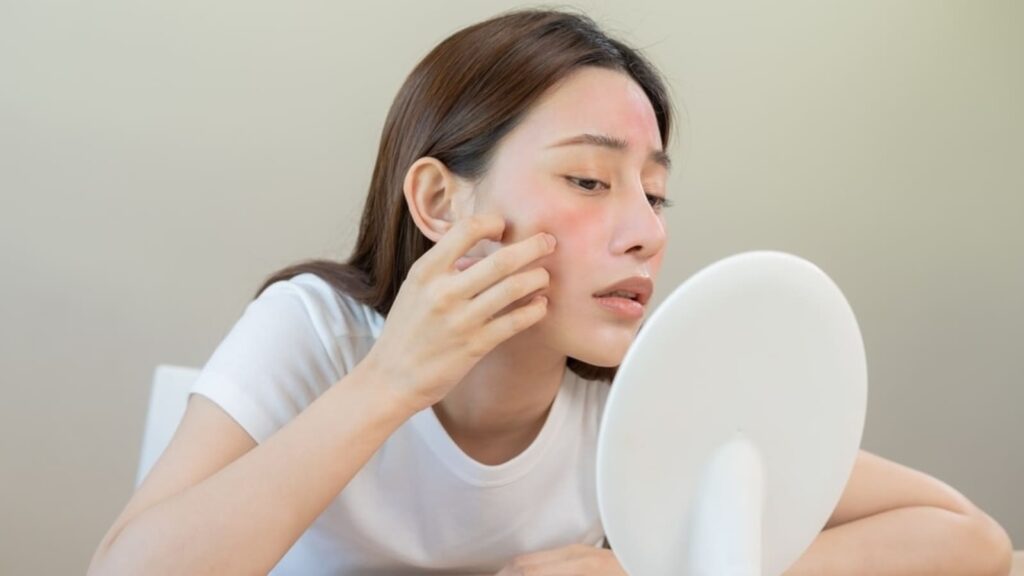 Frequent breakouts this monsoon? Know why acne worsens in rainy season and which dietary habit triggers it | Health