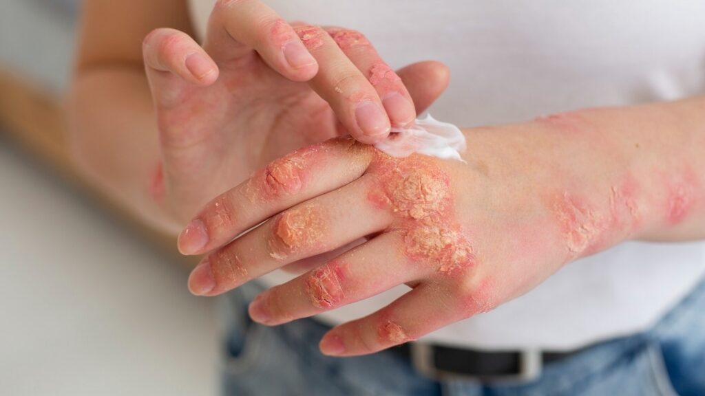 World Eczema Day 2025: Dermatologist reveals who is at risk and shares 11 symptoms; from tiny bumps, redness to rashes