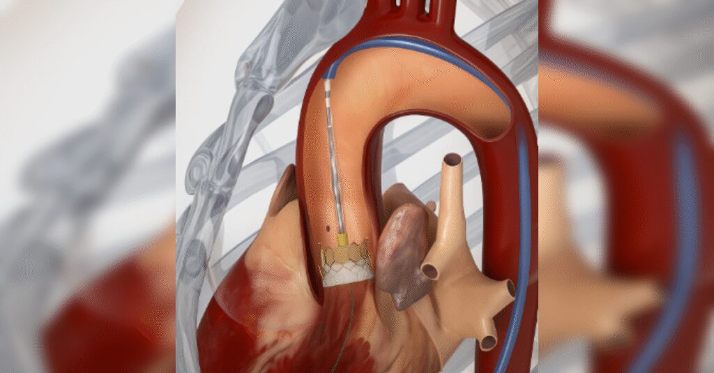 Edwards Lifesciences launches next-generation transcatheter heart valve in india, offering durable, minimally invasive treatment for aortic stenosis