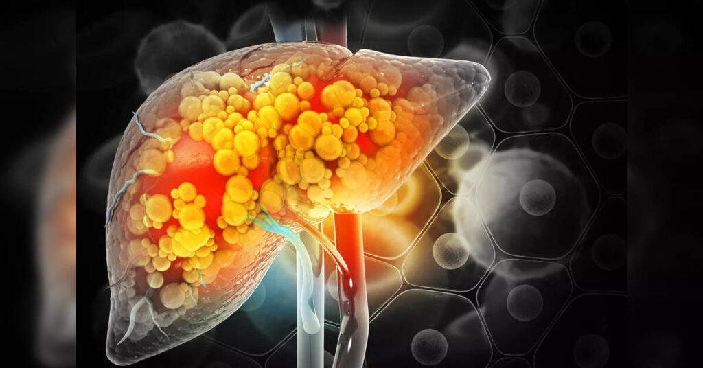 How alcohol contributes to the epidemic of liver disease, ETHealthworld