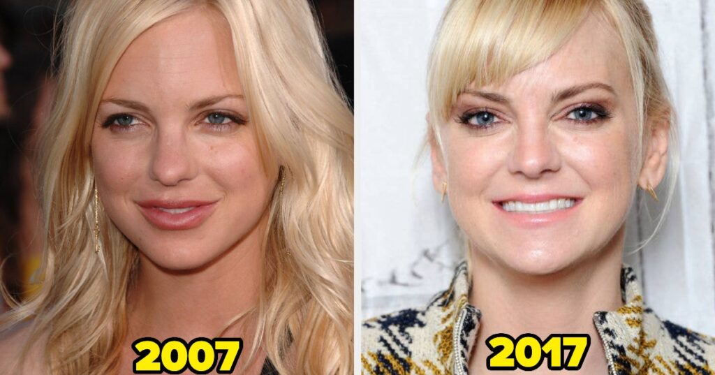 17 Celebs Who Dissolved Or Stop Getting Facial Fillers (And Why)