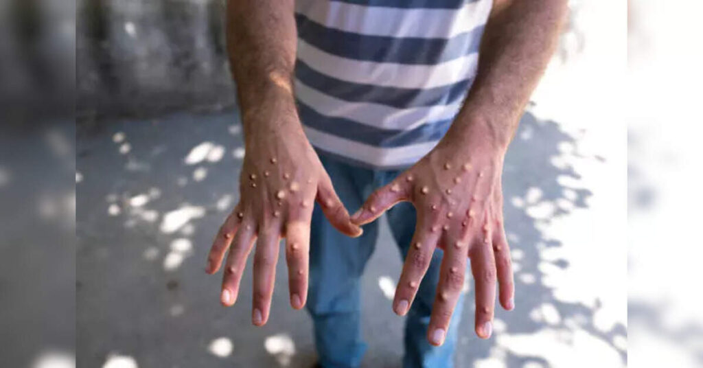 California mpox cases raise concerns. But health officials say the risk remains low, ETHealthworld