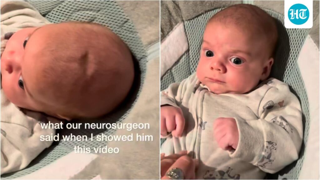 Woman freaks out over her baby’s ‘sunken skull’; neurosurgeon explains the surprising truth behind it