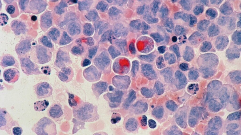 Doctor says easy bruising, bleeding and joint pain can be early warning signs of leukaemia; 6 symptoms to know about