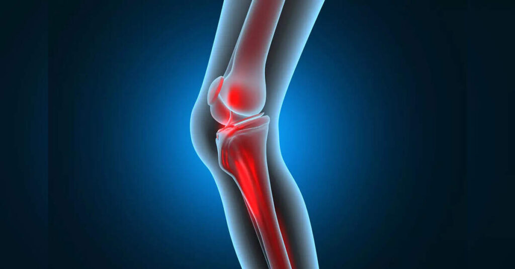 Low-dose radiation safely eases arthritis pain, ETHealthworld