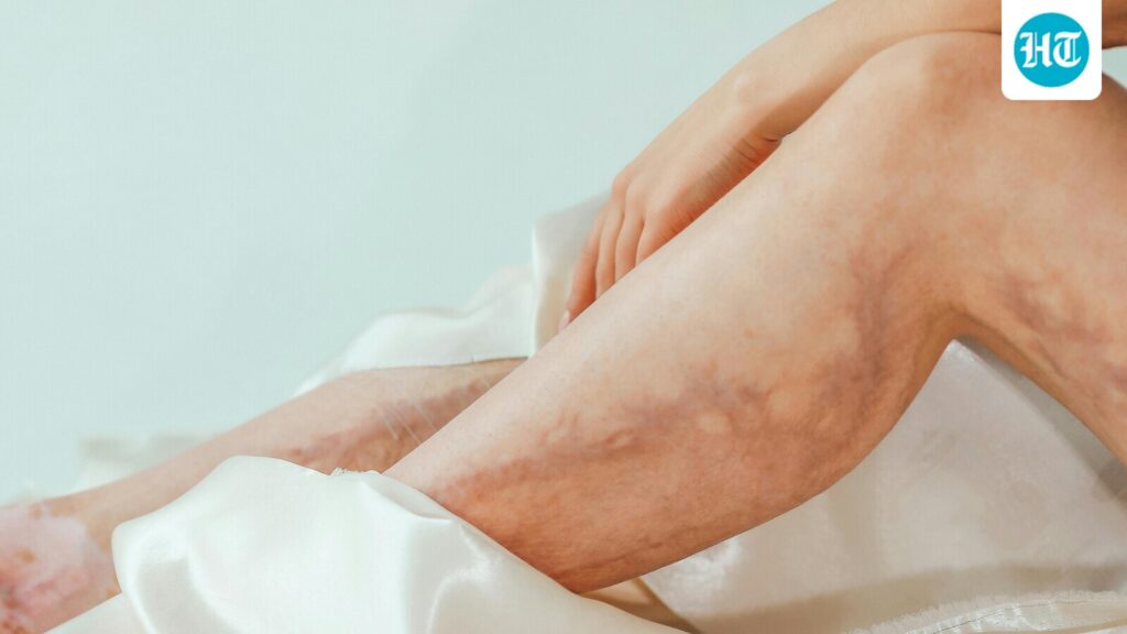 Surgeon explains why women shouldn't ignore leg pain at night: ‘Reflects deeper problems in the circulation…’